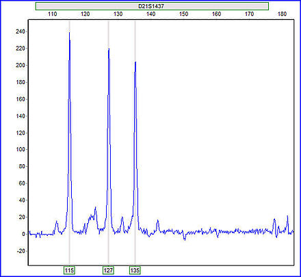 Przykładowy wynik badania, wskazujący Trisomie 21